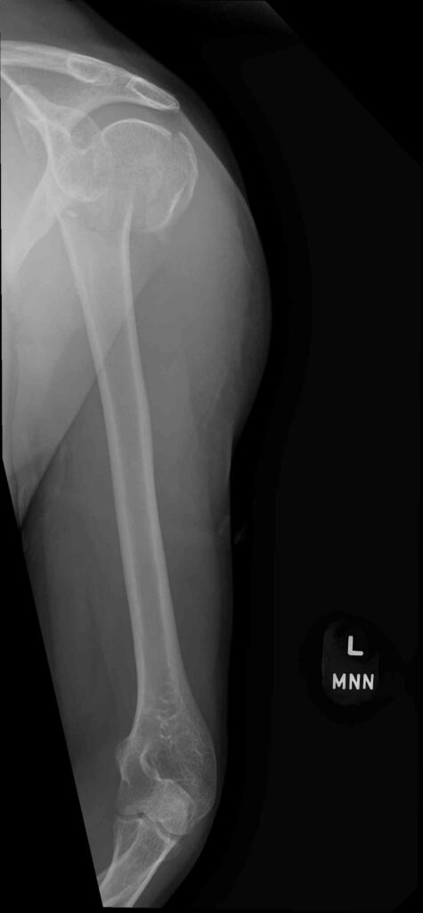 Hannah Foster's injured shoulder x ray