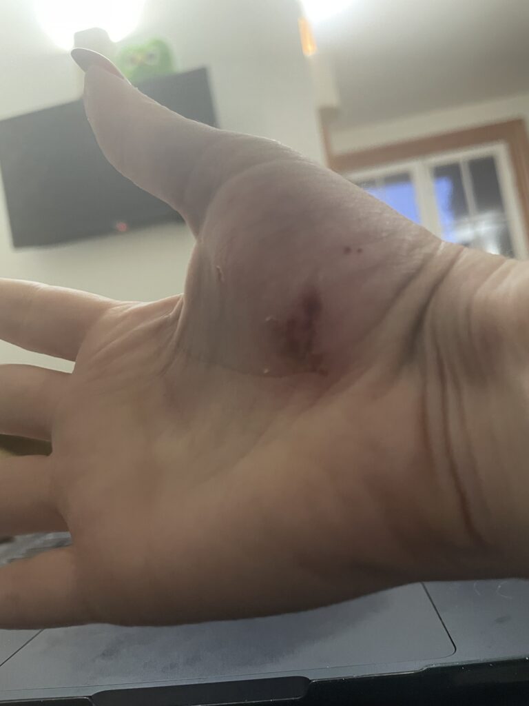 Injuries on Hannah Foster's hand