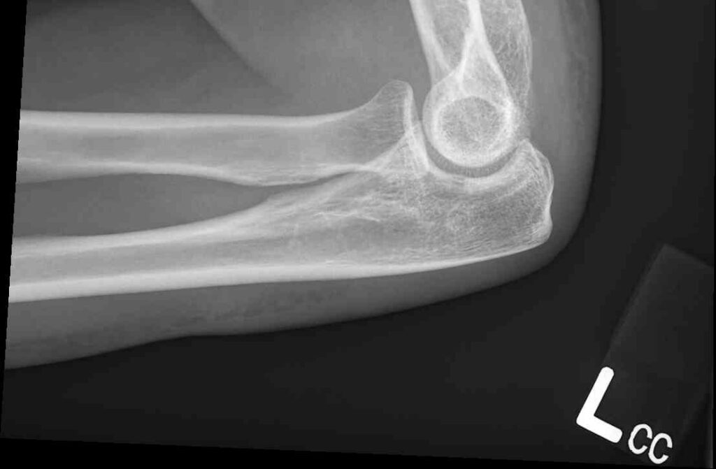 Tissue damage in Hannah Foster's elbow x ray