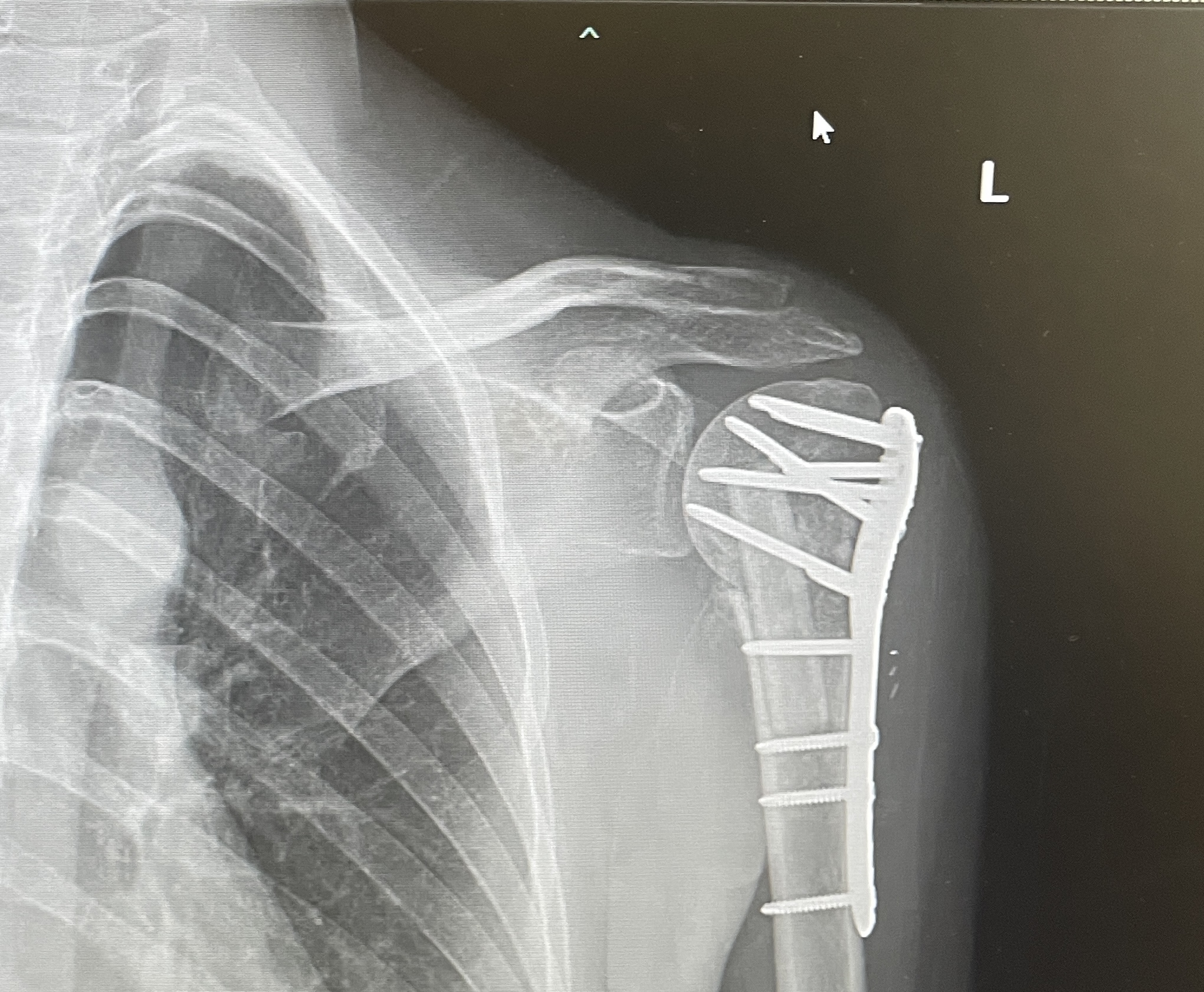 X ray of Hannah Foster's shoulder with surgical screws